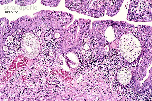 Rhinosporidiose in der Nase  verursacht durch den Pilz Rhinosporidium seeberi. H&E-Färbung. LM X31.