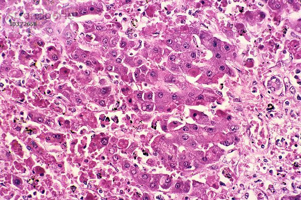 Gelbfieber in der Leber  Nekrose und Rattenkörper  verursacht durch das Gelbfiebervirus  H&E-Färbung. LM X78