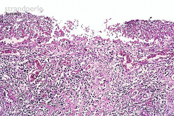 Shigella sonnei Bacteria ist der Erreger der bazillären Dysenterie des Ileums  die Schleimhautgeschwüre verursacht  H&E-Färbung. LM X31.