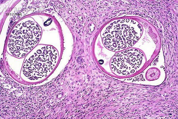 Onchozerkose der Leistengegend  verursacht durch den parasitären Wurm Onchocerca volvulus  H&E-Färbung. LM X31.