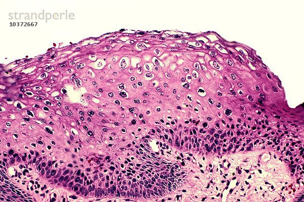 Schnitt durch die Vaginalschleimhaut  der die Auswirkungen des sexuell übertragbaren Humanen Papillomavirus zeigt  H&E-Färbung. LM X64