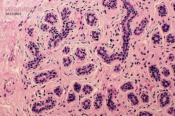 Normales erwachsenes Brustläppchen mit nicht laktierenden Azini  die aus Epithel- und Myoepithelzellen bestehen  H&E-Färbung. LM X64.