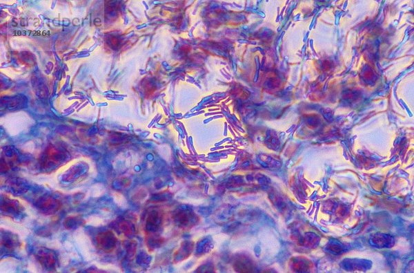 Anthrax-Bakterien (Bacillus anthracis) in infiziertem Gewebe. Phasenkontrast  LM X400.