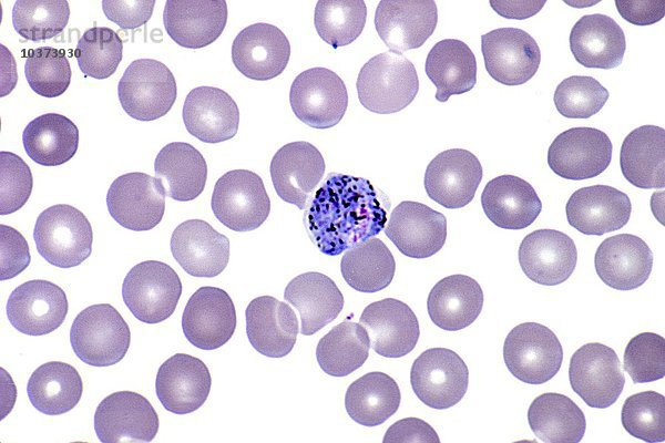 Plasmodium vivax Protozoen im peripheren Blut des Menschen  dem Erreger der gutartigen Tertiärmalaria  mit Schizonten  Wright-Färbung. LM X400