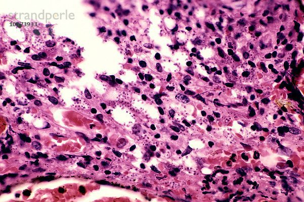 Leishmania braziliensis Protozoen bei einem erwachsenen männlichen Patienten mit einer akuten Form der mukokutanen Leishmaniose  H&E-Färbung. LM X160.