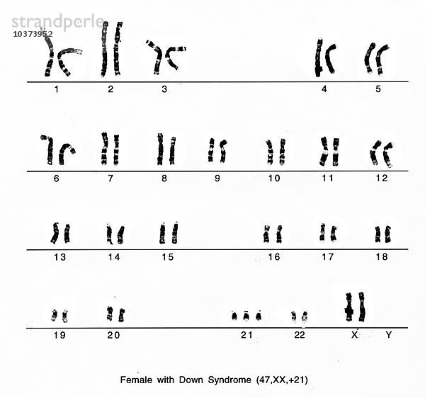 Karyotyp einer Frau mit Down-Syndrom.