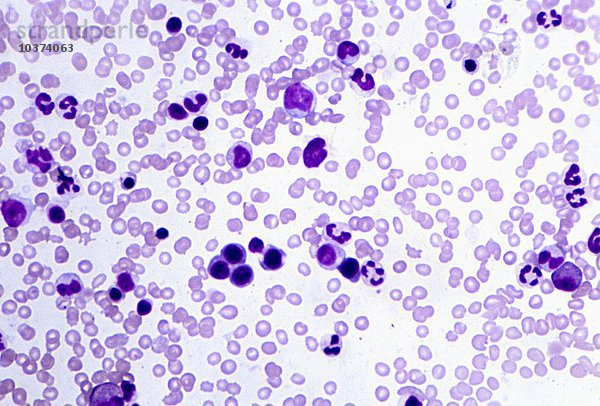Menschlicher Blutausstrich aus dem Knochenmark mit roten Blutkörperchen (Erythrozyten) und weißen Blutkörperchen (Leukozyten). LM X120.