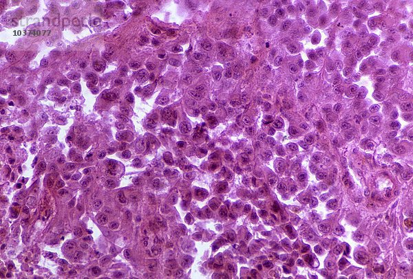 Menschliches Gewebe mit melanotischem Sarkom. LM X220.