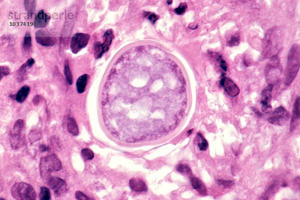 Der Pilz Coccidioides immitis verursacht die Kokzidioidomykose oder das Talfieber. Hier sieht man ein Kügelchen in der menschlichen Blasenwand. LM X400