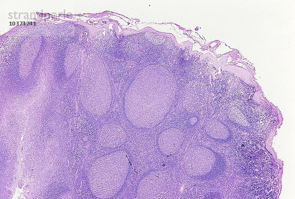 Menschliche Mandelentzündung (Tonsillitis)  die einen Querschnitt durch die aufgrund einer Infektion vergrößerte Lymphdrüse im Rachen zeigt. LM X5.