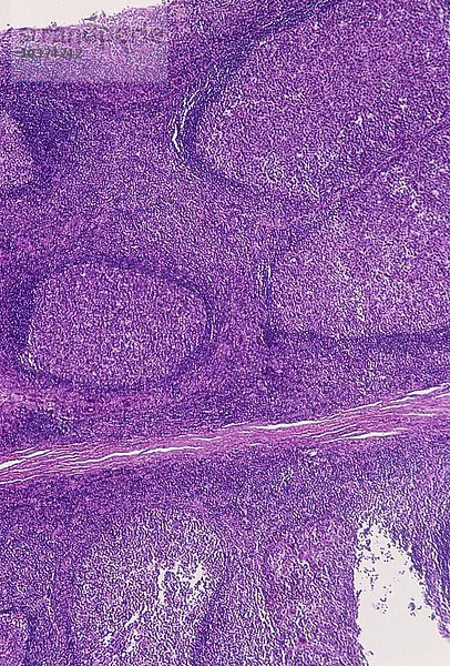 Menschliche Mandelentzündung (Tonsillitis)  zeigt einen Querschnitt durch die aufgrund einer Infektion vergrößerte Lymphdrüse im Rachen. LM X20.