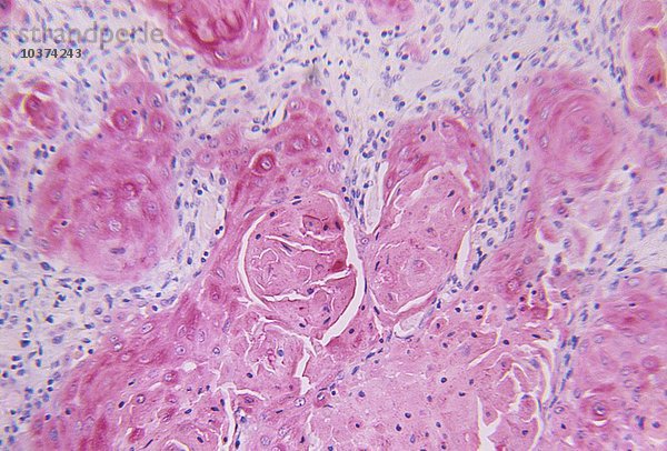 Menschliche Tonsillitis  zeigt Zelldetails in einem Querschnitt durch die aufgrund einer Infektion vergrößerte Lymphdrüse im Rachen. LM X60.