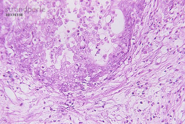 Querschnitt durch den menschlichen Eierstock mit Krukenberg-Tumor. Dieses Karzinom ist in der Regel eine Metastase von Krebs des Verdauungstrakts  insbesondere des Magens. LM X80.