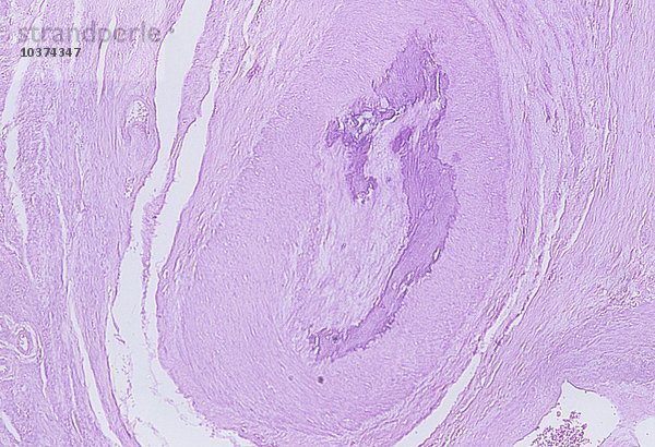 Querschnitt durch die menschliche Gebärmutter mit Sklerose. LM X15.