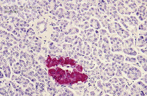 Menschliche Pankreas-Insel von Langerhans  Insulin-Antikörper-Färbung. LM X80.