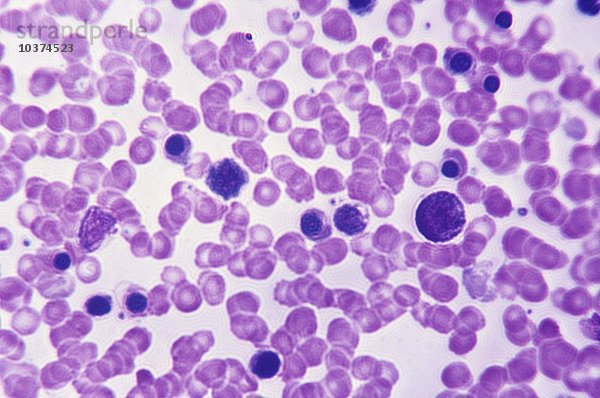 Erythroblastose des menschlichen Blutes. LM X200.