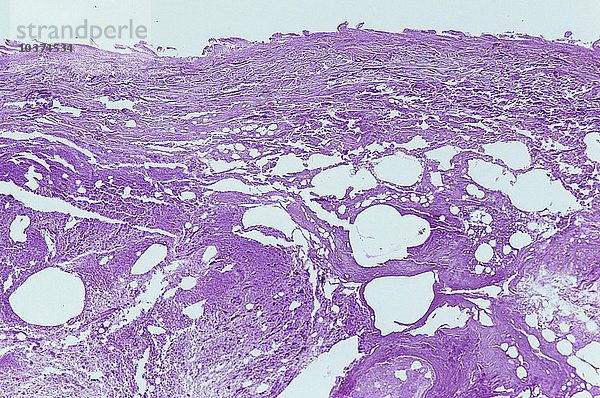 Querschnitt durch die menschliche Haut mit gangränöser Nekrose. LM X7.