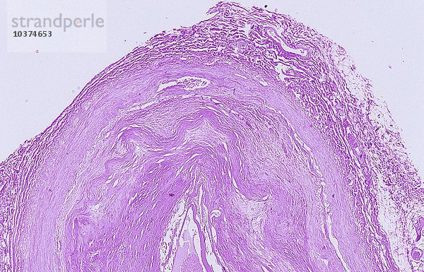 Querschnitt durch die Wand einer menschlichen atherosklerotischen Arterie. LM X7.