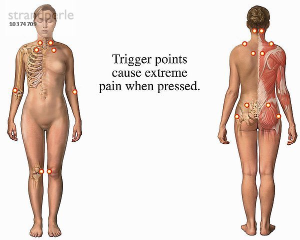 Dieses medizinische Exponat zeigt die Triggerpunkte auf  die mit dem Fibromyalgie-Syndrom (FMS) oder dem myofaszialen Schmerzsyndrom in Verbindung stehen. Die Druckpunkte sind auf zwei Ansichten der weiblichen Figur dargestellt  der vorderen (Vorderseite) und der hinteren (Rückseite).