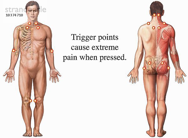 Biomedizinische Illustration  die die Triggerpunkte im Zusammenhang mit dem Fibromyalgie-Syndrom (FMS) oder dem myofaszialen Schmerzsyndrom zeigt. Die Druckpunkte sind angedeutet und auf der Vorder- (Vorderseite) und Rückseite (Rückseite) der männlichen Figur zu sehen.
