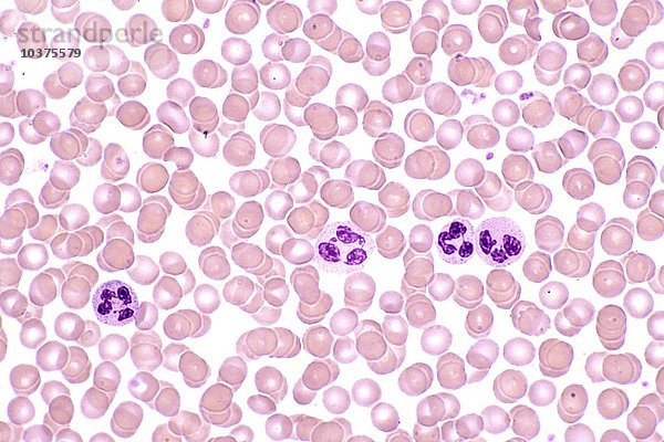 Menschlicher Blutausstrich mit roten Blutkörperchen (Erythrozyten) und weißen Blutkörperchen (Leukozyten). LM