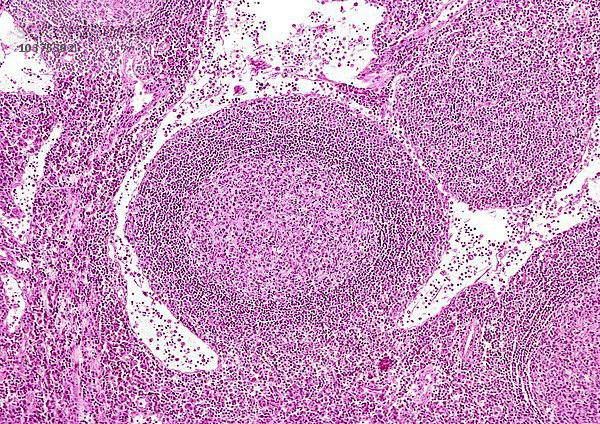 Menschlicher sekundärer Lymphknotenfollikel  gekennzeichnet durch ein blasses Keimzentrum mit einer Mantelzone aus kleinen Lymphozyten  H&E-Färbung. LM X26
