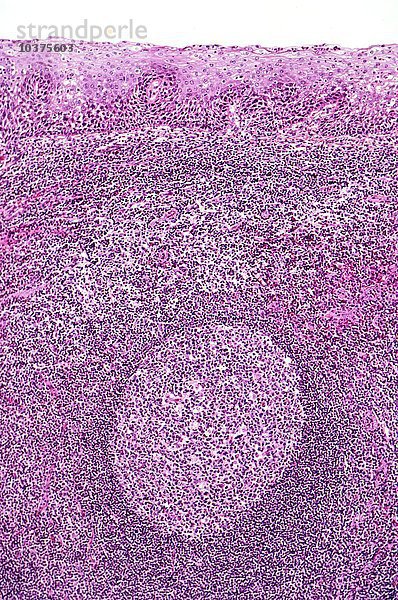 Normale menschliche Tonsille mit geschichteter Plattenepithelschleimhaut oberhalb und lymphatischem Gewebe unterhalb eines lymphatischen Follikels  H&E-Färbung. LM X26.