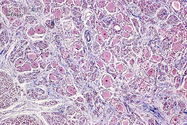 Menschliches Ganglion des autonomen Nervensystems mit einer Ansammlung von Neuronen mit reichlich rosa Zytoplasma und kleinen Kernen  Trichromfärbung. LM X26