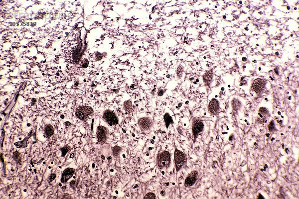 Alzheimer-Krankheit mit neurofibrillären Verästelungen im Kleinhirn eines Menschen  Silberfärbung. LM X250.
