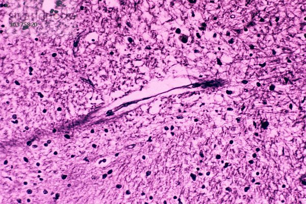 Alzheimer-Gehirn mit neurofibrillären Knäueln im Kleinhirn. LM X160