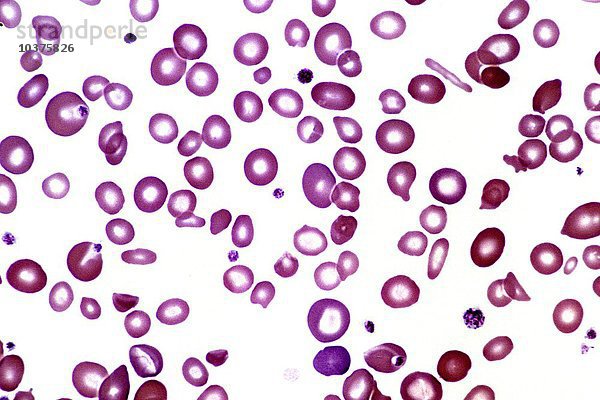 Schwere Eisenmangelanämie mit hypochromen  blassen  hämoglobinarmen  mikrozytären  kleinen und missgebildeten roten Blutkörperchen in einem menschlichen peripheren Blutausstrich  Wright-Färbung. LM X252