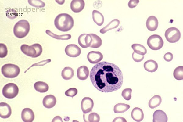 Schwere Eisenmangelanämie mit hypochromen  blassen  hämoglobinarmen  mikrozytären  kleinen und missgebildeten roten Blutkörperchen in einem menschlichen peripheren Blutausstrich  Wright-Färbung. LM