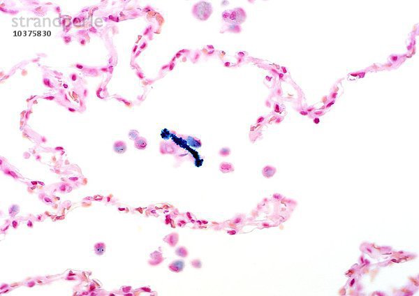 Asbestose eisenhaltig mit Asbestfasern  Blaufärbung  bedeckt mit Eisen- und Proteinkomplexen in einer menschlichen Lunge. LM X100