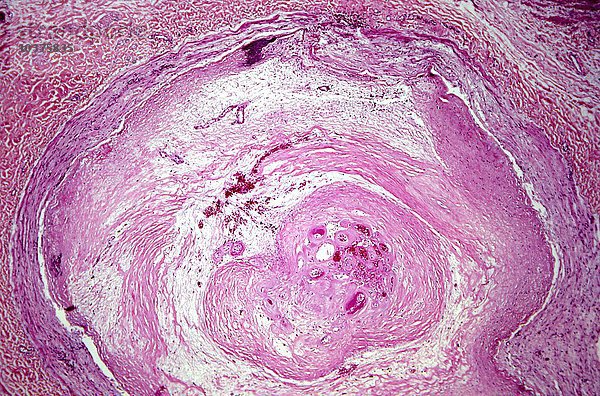 Atherosklerose einer menschlichen Arterie mit vollständigem Verschluss und Verkalkung in der Wand  H&E-Färbung. LM X10