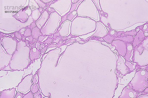 Querschnitt durch eine menschliche Schilddrüsenknotenstruma. LMX15