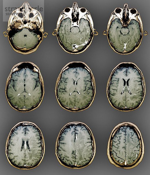 Normales Gehirn  MRI-Scans