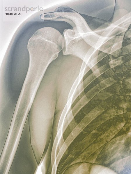 Normale Schulter  Röntgenbild