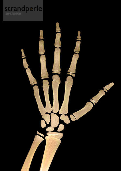 Berechnung des Knochenalters mit einem Röntgenbild. Röntgenbild einer 12 Jahre alten Hand. Normale Größe