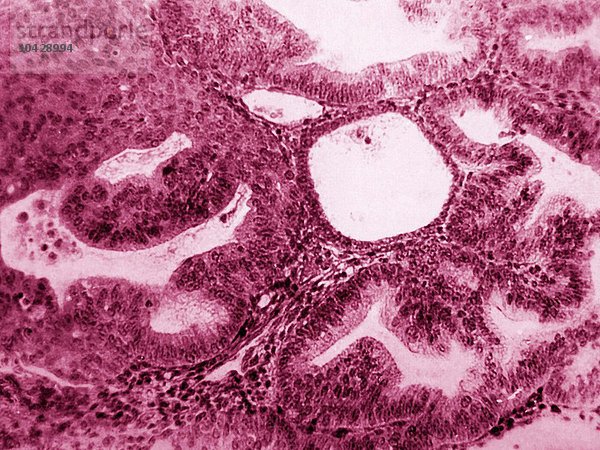 Krebs der Gebärmutter. Adeno-Akanthom (Drüsentumor). Krebs der Gebärmutterschleimhaut entwickelt sich aus der Gebärmutterschleimhaut. Mikroskopie eines histologischen Schnitts.