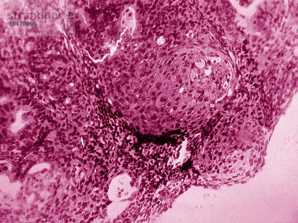 Krebs der Gebärmutter. Adeno-Akanthom (Drüsentumor). Krebs der Gebärmutterschleimhaut entwickelt sich aus der Gebärmutterschleimhaut. Mikroskopie eines histologischen Schnitts.