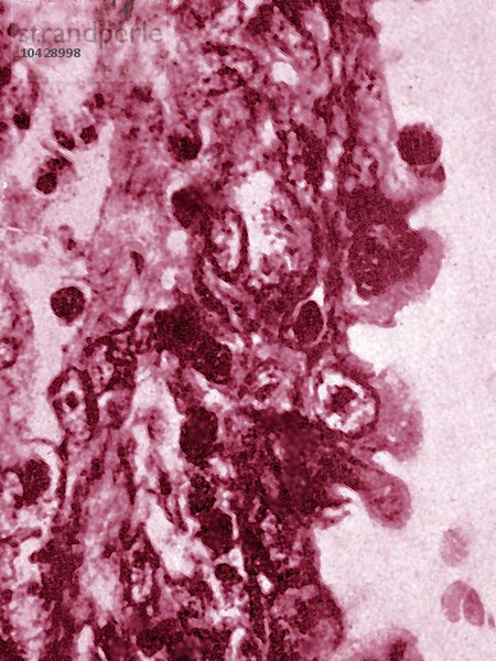 Gebärmutterhalskrebs. Zelluläre Anomalien  die bei der Mikroskopie eines histologischen Schnitts des endozervikalen Epithels sichtbar werden.