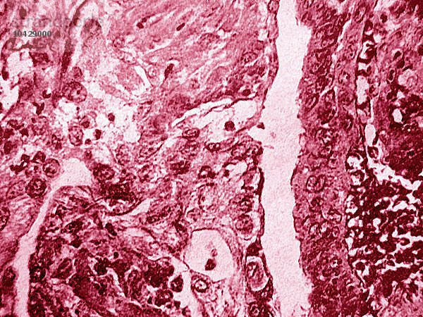 Gebärmutterhalskrebs. Plattenepithelmetaplasie  die bei der Mikroskopie eines histologischen Schnitts des Endozervixepithels sichtbar wird.
