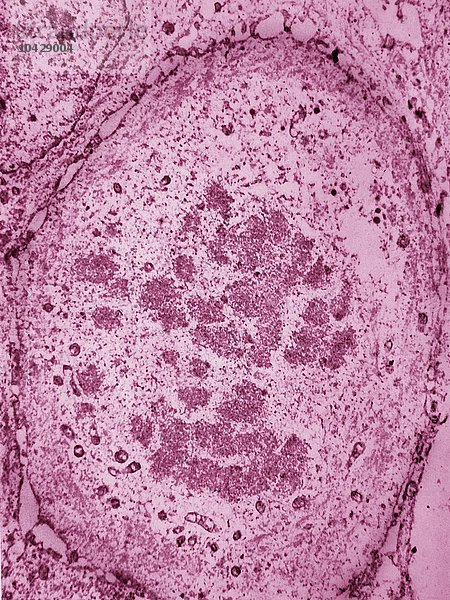 Stratifiziertes intraepitheliales Karzinom (Zellteilung). Gebärmutterhalskrebs. Mikroskopie eines histologischen Schnitts x 7500.