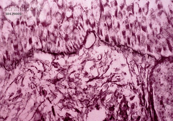 Stratifiziertes intraepitheliales Karzinom (Zellteilung). Gebärmutterhalskrebs. Mikroskopie eines histologischen Schnitts x 400.