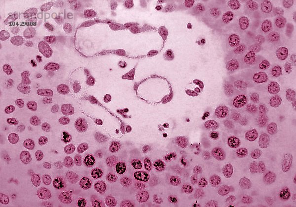 Invasives Basalzellkarzinom  Krebs der Gebärmutter. Mikroskopie eines histologischen Schnitts x 500.