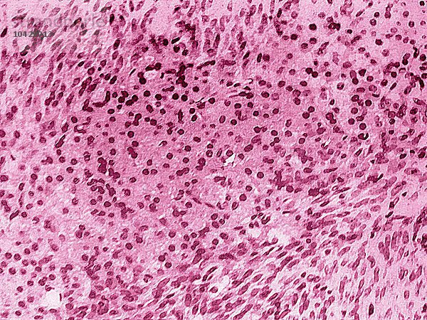 Ovariales Thekom  Eierstockkrebs im Thekalbereich (Follikelhülle der Eierstöcke). Mikroskopie eines histologischen Schnitts des Eierstocks.