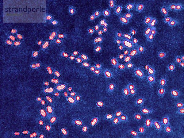 Pneumokokken (Streptokokkus pneumoniae). Pneumokokken sind das Bakterium  das Lungenentzündung  Bronchialpneumonie  eitrige Rippenfellentzündung  bakterielle Hirnhautentzündung  Ohrinfektionen  Nasennebenhöhlenentzündung und Bindehautentzündung verursacht. Optische Mikroskopie x 2000.