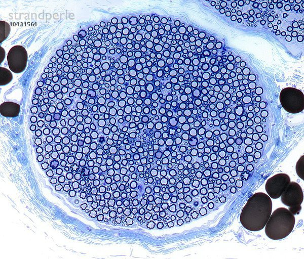 Nervenbündel. Lichtmikroskopische Aufnahme eines Schnitts durch ein Nervenbündel aus dem Ischiasnerv. Zu erkennen sind Myelinscheiden (dunkelblaue Kreise)  die die Axone (hellblaue Punkte) umgeben. Das Perineurium (Bindegewebe  hellblau) umgibt das Nervenbündel. Adipose (Fett)-Zellen (dunkelbraun) umgeben das Nervenbündel. Vergrößerung: x200 bei einem Druck von 10 Zentimetern Breite.