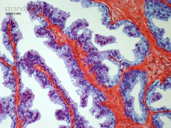 Prostatakrebs. Lichtmikroskopische Aufnahme eines Schnitts durch ein Karzinom (Krebs) der Prostata. Vergrößerung: x200 bei einem Druck von 10 Zentimetern Breite.