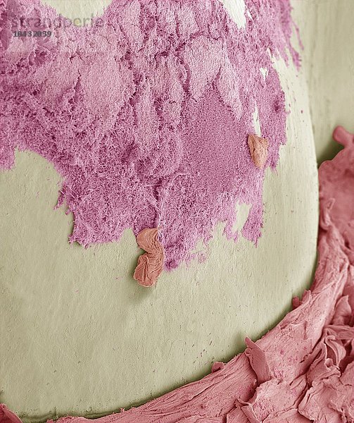 Zahnbelag. Farbige Rasterelektronenmikroskop-Aufnahme (SEM) von Zahnbelag (rosa) auf einem Zahn. Plaque besteht aus einem Film von Bakterien  die in eine Glykoproteinmatrix eingebettet sind. Die Matrix wird aus bakteriellen Sekreten und Speichel gebildet. Vergrößerung: x300 bei einer Druckbreite von 10 Zentimetern Zahnbelag  SEM